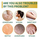 Treatment of vitiligo psoriasis with 311 NM narrow-band ultraviolet light by UVB phototherapy instrument