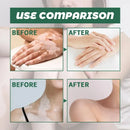 Treatment of vitiligo psoriasis with 311 NM narrow-band ultraviolet light by UVB phototherapy instrument